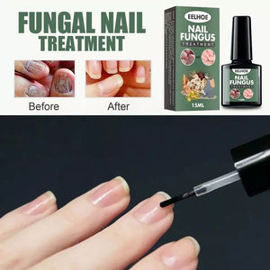 Best Fungal Nail Treatment Liquid | Highly Effective | Kills Toenail Fungus