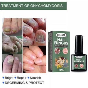 Best Fungal Nail Treatment Liquid | Highly Effective | Kills Toenail Fungus