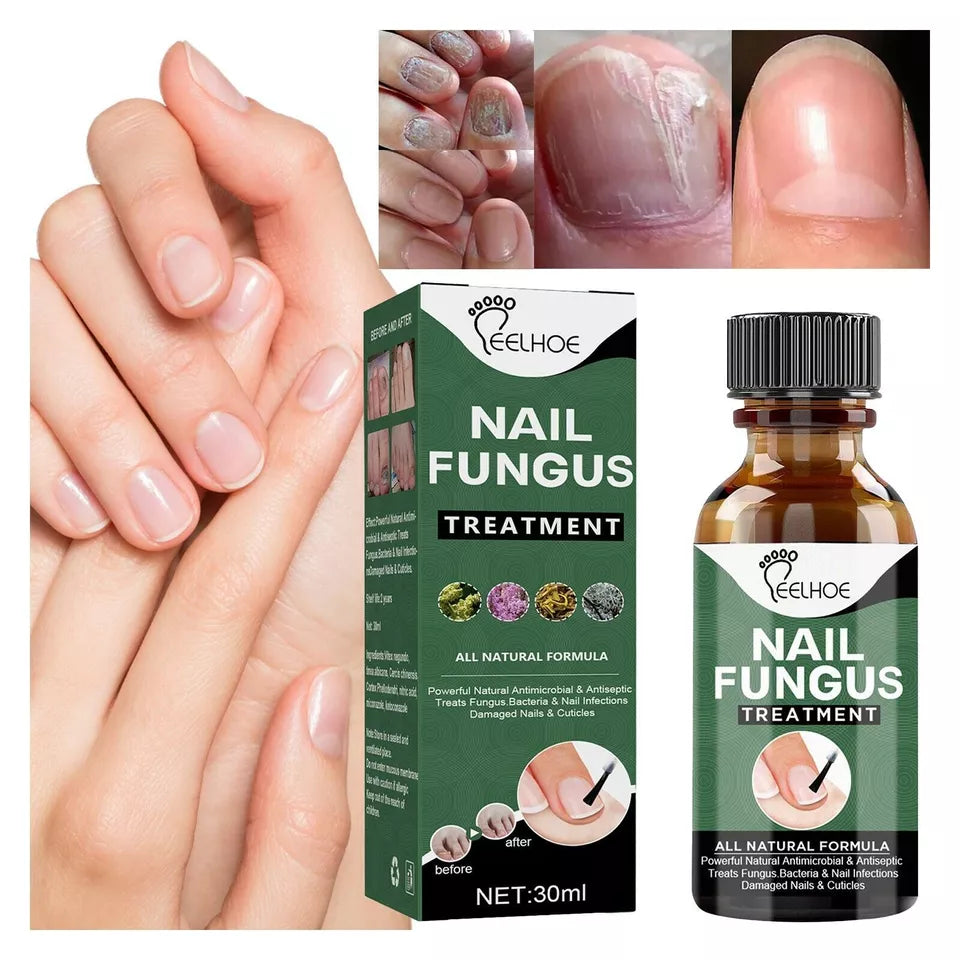 Best Fungal Nail Treatment Liquid | Highly Effective | Kills Toenail Fungus