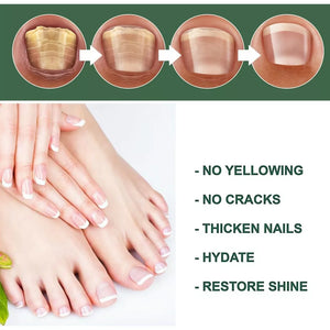 Best Fungal Nail Treatment Liquid | Highly Effective | Kills Toenail Fungus