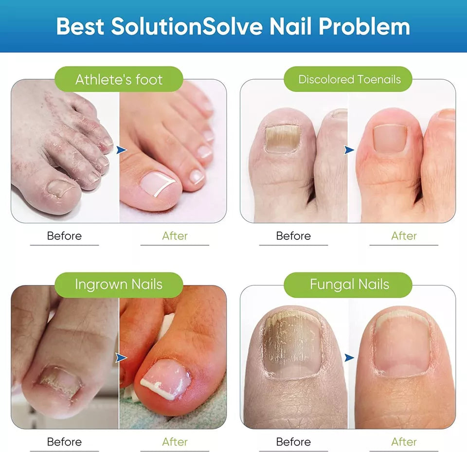 Best Fungal Nail Treatment Liquid | Highly Effective | Kills Toenail Fungus