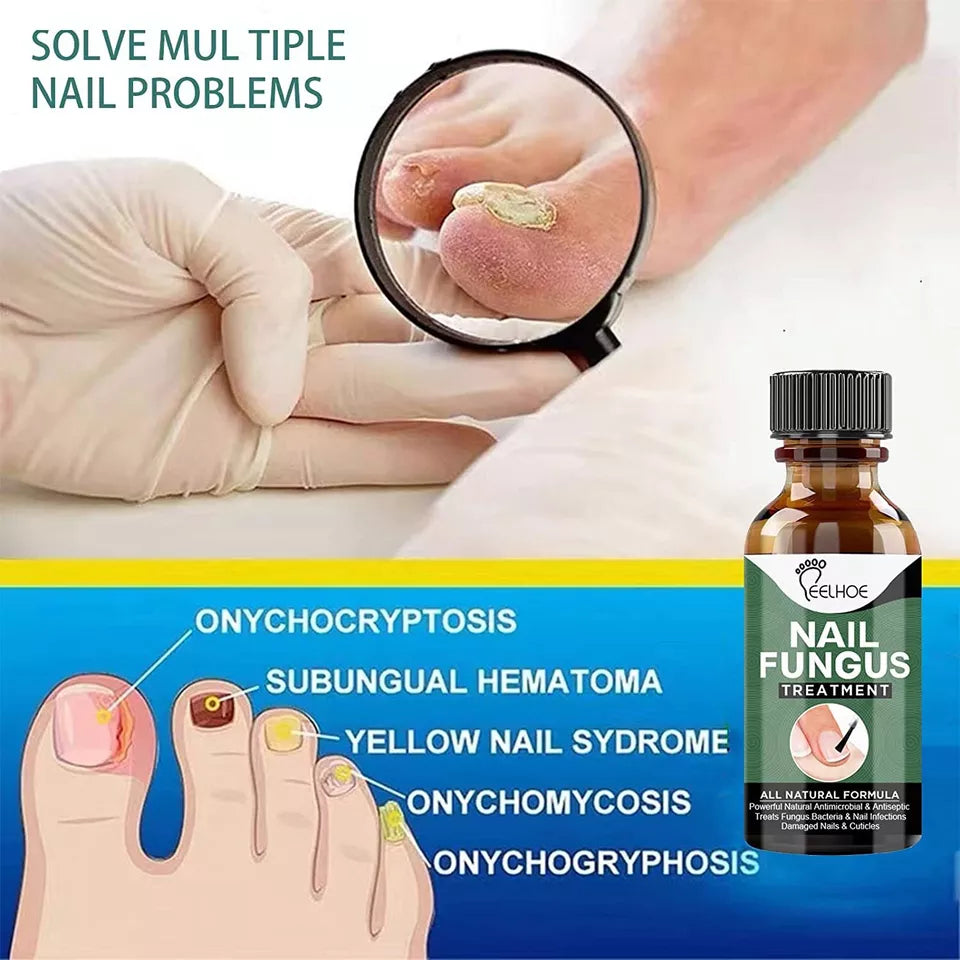 Best Fungal Nail Treatment Liquid | Highly Effective | Kills Toenail Fungus