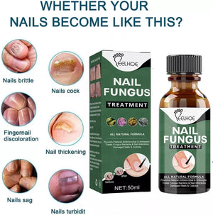 Best Fungal Nail Treatment Liquid | Highly Effective | Kills Toenail Fungus